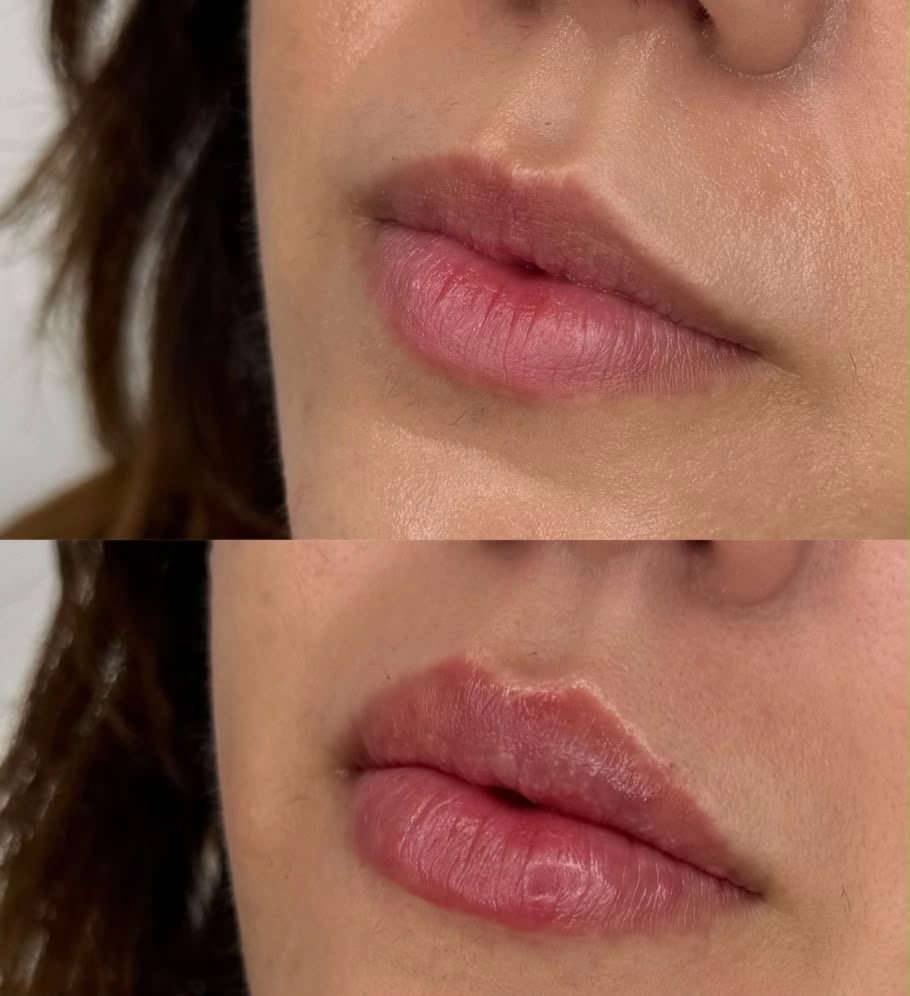 Lip treatment result